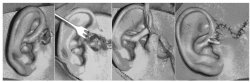 耳前组织整块切除及皮瓣修复治疗复杂性先天性耳前瘘管30例